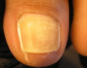 Коррекция вросшего ногтя